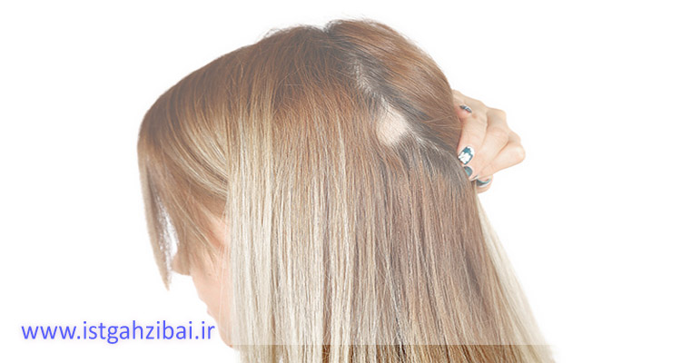 ریزش مو سکه ای خانم ها